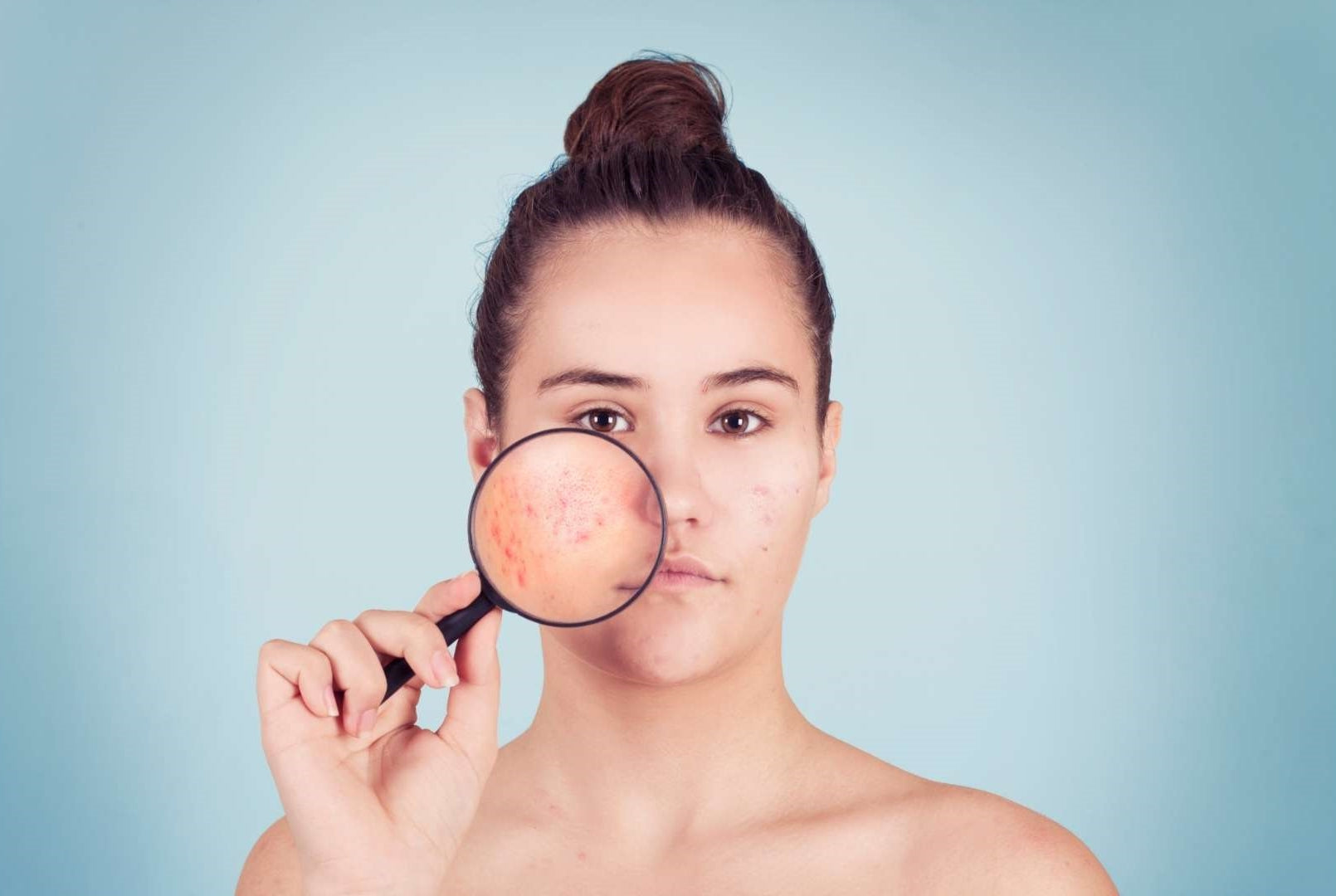 Vitamins as an Acne Solution?