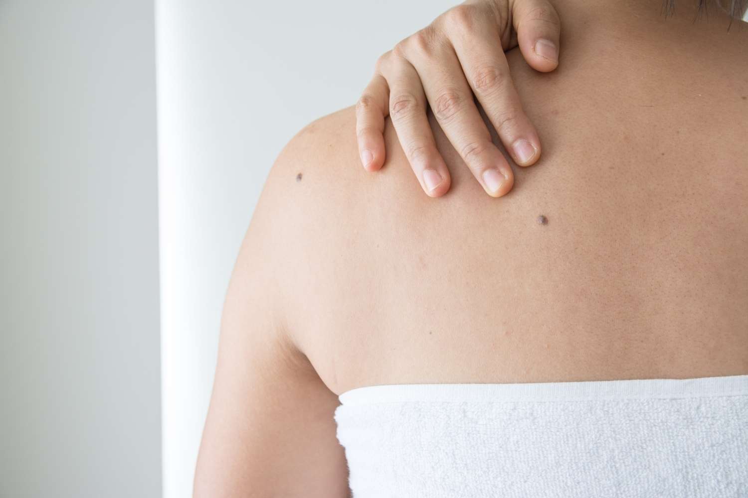 Melanoma: What and Where to look for during Self Exams